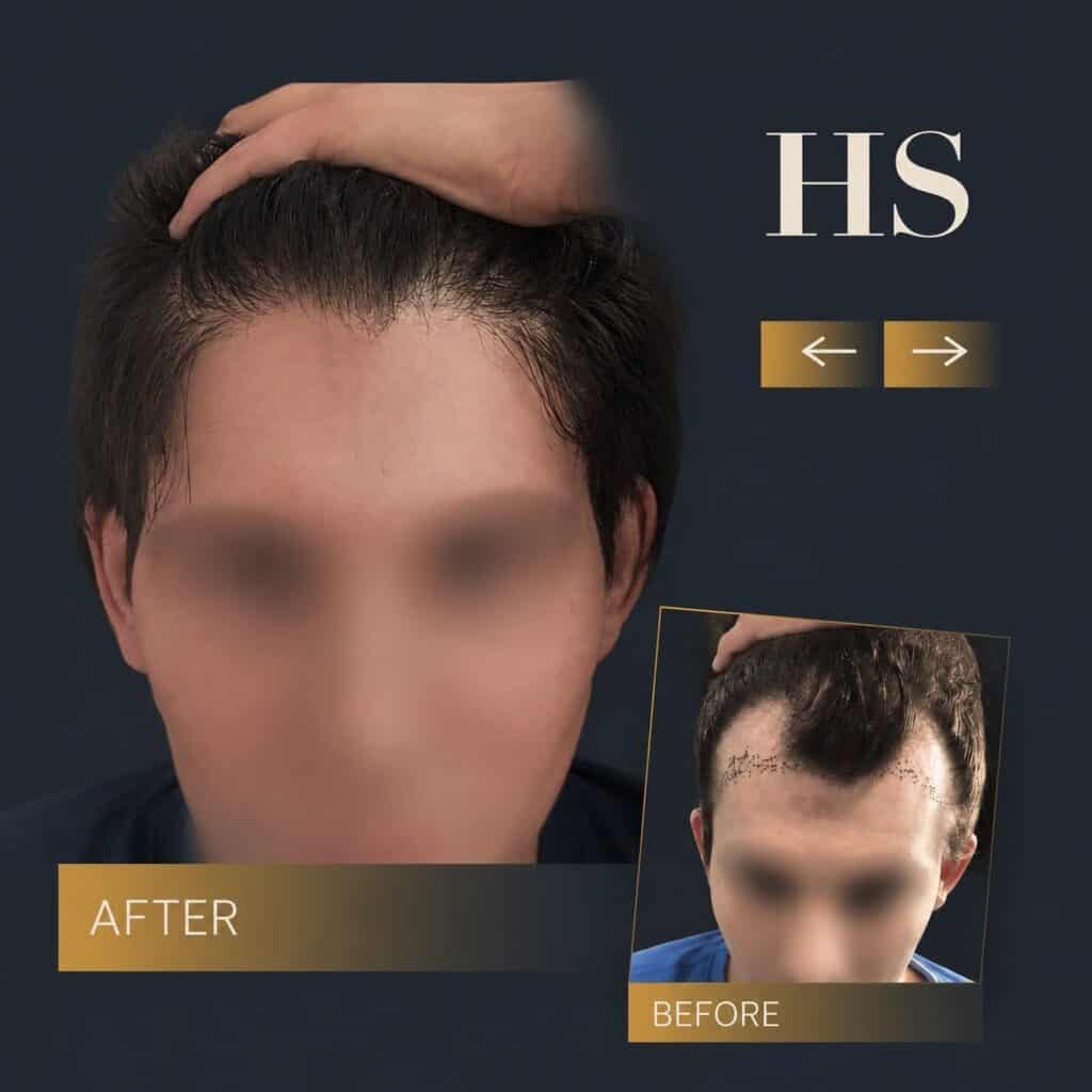 Charlotte Harley Street transgender hair transplant before and after