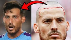 David Silva hair transplant before and after