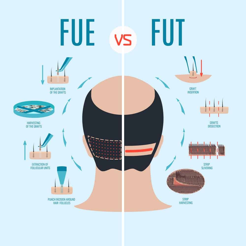 Home 13 FUE vs FUT in hair transplant methods-min
