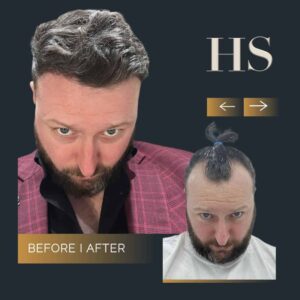 Hairline Hair Transplant 5 Hairline Hair Transplant 2