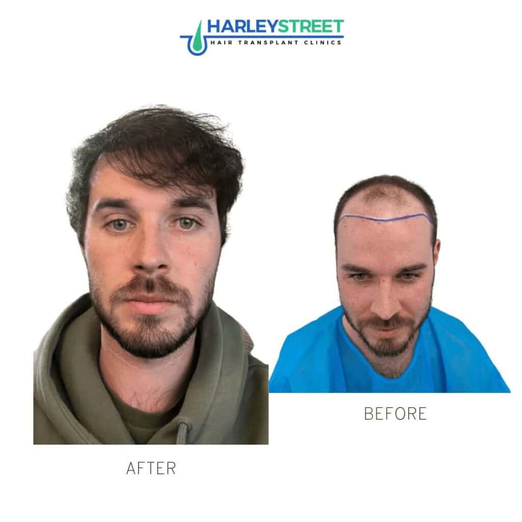 Tom-Francis-before-and-after