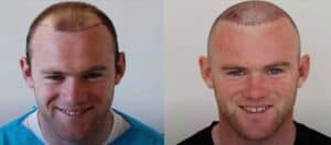 Wayne Rooney before and after hair transplant