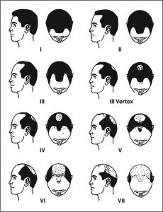 Male Pattern Baldness 1 male-pattern-baldness-or-androgenetic-alopecia-230x300
